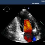 Ecocardiografia bidimensionale