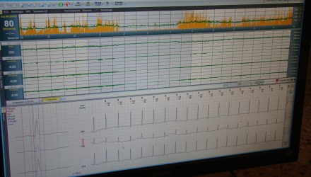 Elettrocardiogramma secondo Holter