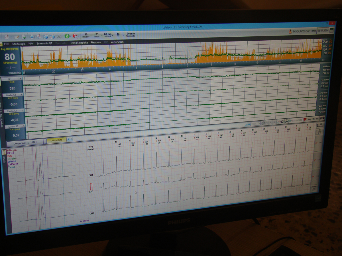 Elettrocardiogramma secondo Holter