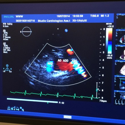 Ecocolor doppler vascolare