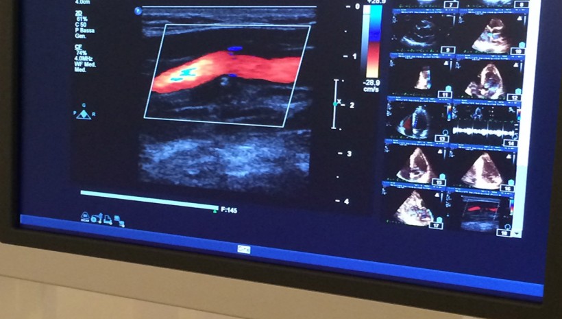 Ecocolor doppler vascolare