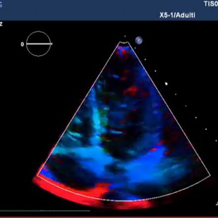 Doppler tissutale, Strain rate e Speckle tracking