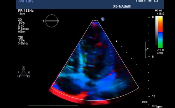 Doppler tissutale, Strain rate e Speckle tracking