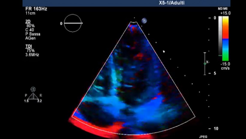 Doppler tissutale, Strain rate e Speckle tracking