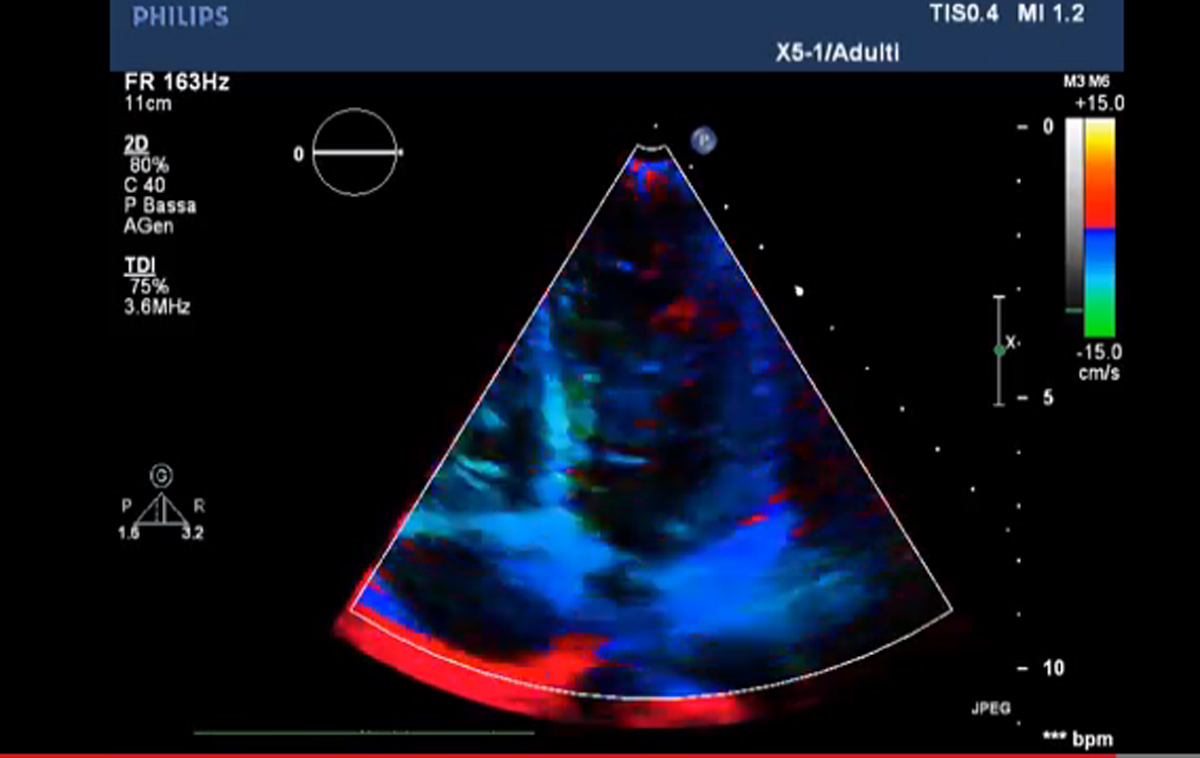 Doppler tissutale, Strain rate e Speckle tracking